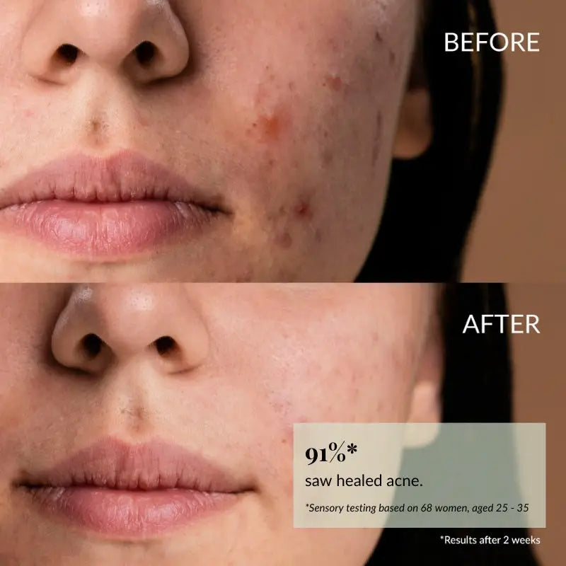 IREN Shizen Clearer Days 20ml – Japán Anti-Akne Szérum Niacinamiddal, Szőlőkivonattal és BIYUSEN Termálvízzel a Tisztább, Nyugodtabb és Egységesebb Arcbőrért
